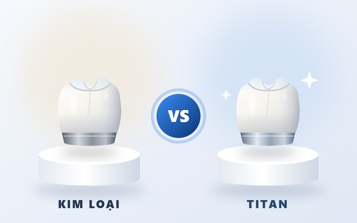 So sánh răng sứ Kim Loại và sứ Titan: Nên chọn loại nào?